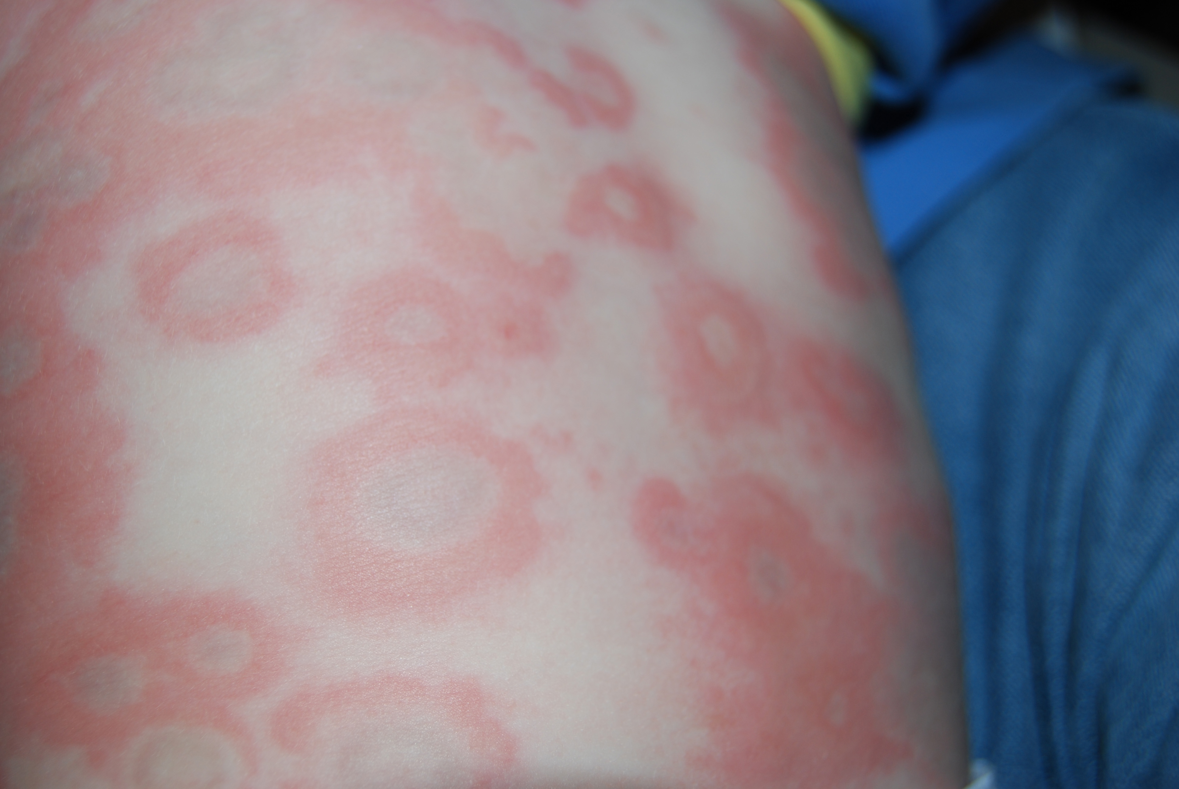 Itchy rash on palms of hands - Dermatology - MedHelp