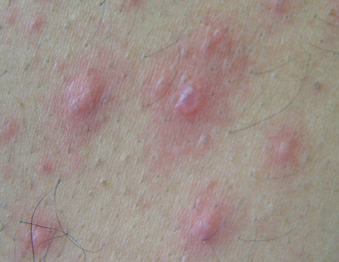 Dermatology quiz, questions, images and picutres for ...