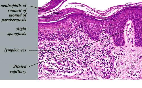 psoriatic lesions #10