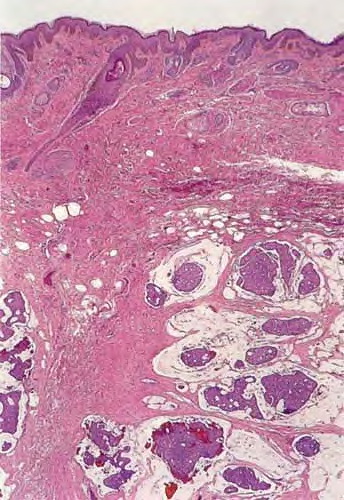 Eccrine carcinoma: a rare cutaneous neoplasm | Diagnostic ...