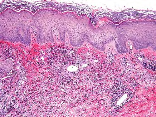 Neutrophilic dermatoses: pyoderma gangrenosum and Sweet's ...