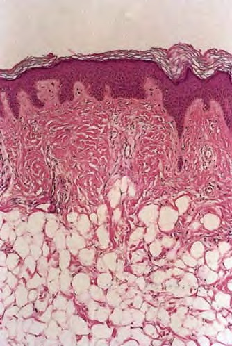 Pathology Outlines - Nevus lipomatosus superficialis