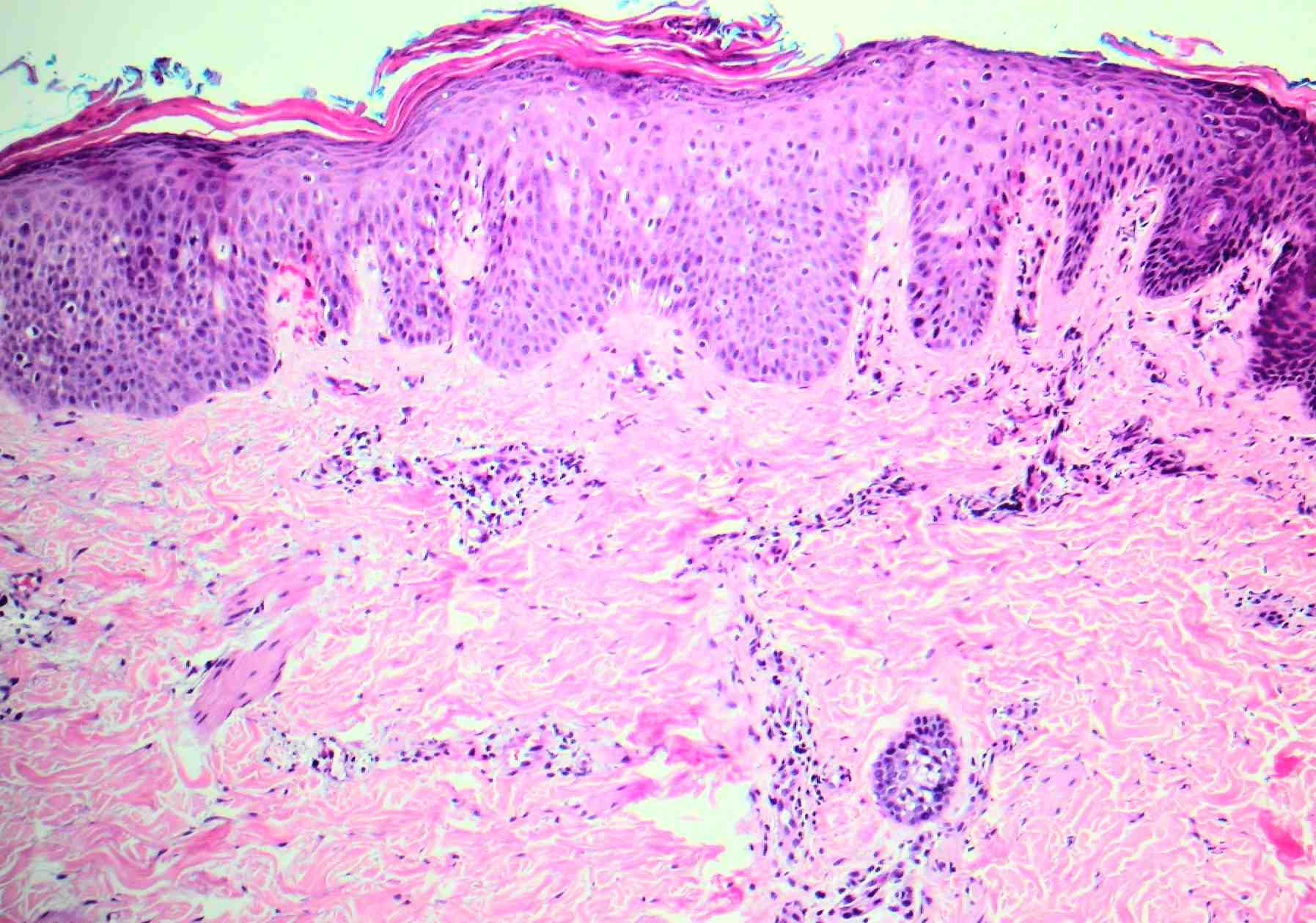 subcorneal pustular dermatosis #11