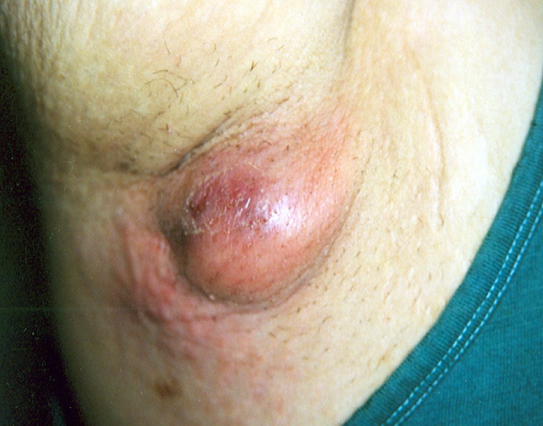 фурункул на груди у женщин лечение фото 32