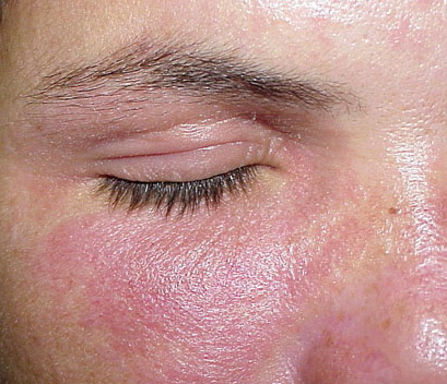Nail polish dermatitis = التهاب الجلد بسبب طلاء الاظافر