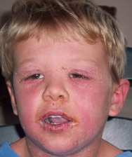 Staphylococcal scalded skin syndrome = متلازمة الجلد المسموط بالجراثيم ...