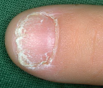 JCM | Free Full-Text | Nail Apparatus Melanoma: Current Management and  Future Perspectives