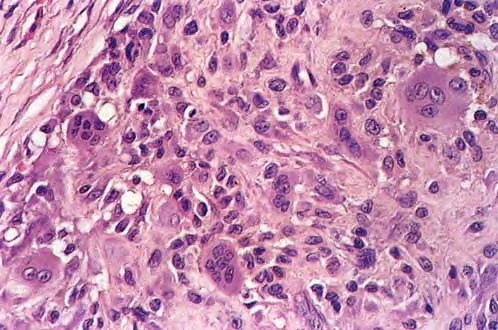 Giant Cell Tumor Of Tendon Sheath ورم الخلايا العملاقة لغمد الوتر