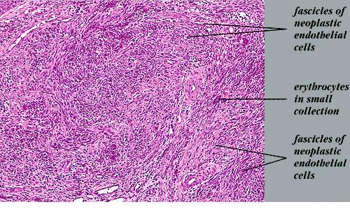 Kaposi's sarcoma, hemorrhagic papulo-nodule =غرن كابوزي الحطاطي العقيدي ...