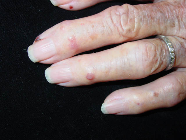 Bullous disease of dialysis=الداء الفقاعي الناتج عن التحال الدموي