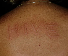 Dermographic urticaria= الكتوبية الجلدية =الجلد القرطاسي