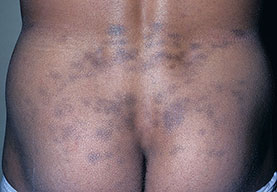 Erythema dyschromicum perstans = الحمامى الدائمة بخلل التلون