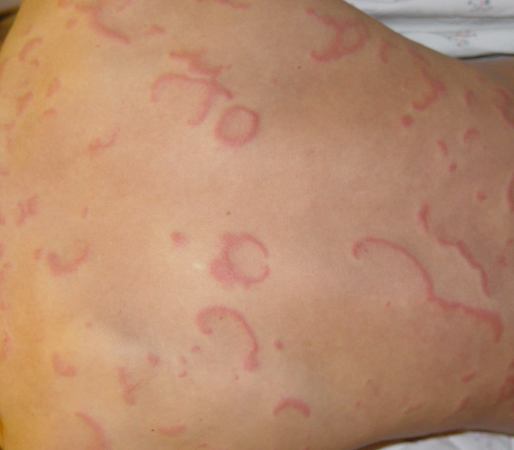 Familial annular erythema =الحمامى الحلقية العائلية