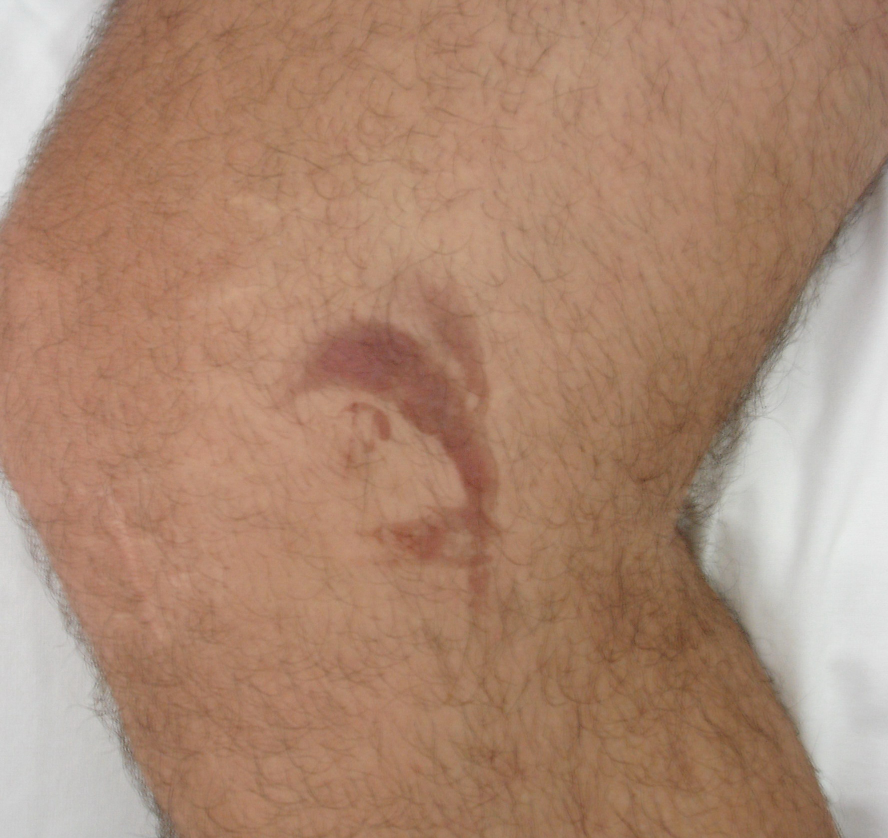 Ice burn = حرق بالثلج