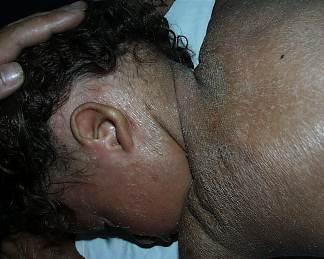 Lamellar ichthyosis = السماك الصفيحي