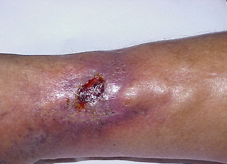 Stasis ulcer =القرحة الركودية