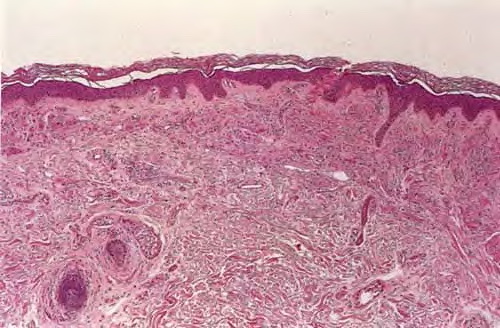 Multicentric reticulo histiocytosis = داء كثرة الناسجات الشبكي متعدد المراكز